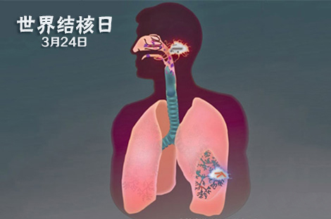 2016世界防治结核病日 关注肺结核病远离"潜在杀手"